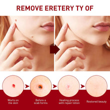 Load image into Gallery viewer, Buy 1 Get 1 FREE šāØTags & Moles Remover,! āØ